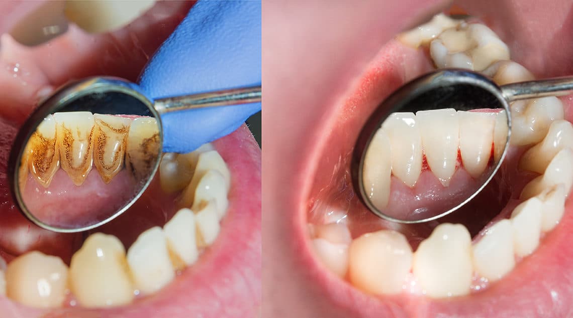 Plaque and Tartar on Teeth